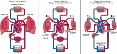 The heart in congenital diaphragmatic hernia: Knowns, unknowns, and future priorities